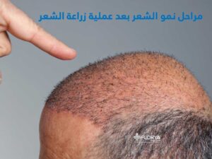 Read more about the article مراحل نمو الشعر بعد عملية زراعة الشعر
