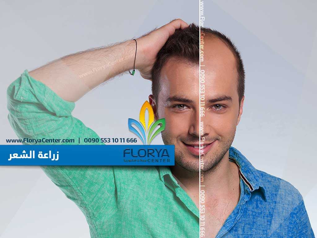 Read more about the article زراعة الشعر