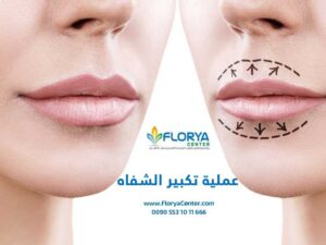 Read more about the article عملية تكبير الشفاه