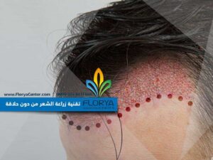 Read more about the article تقنية زراعة الشعر من دون حلاقة