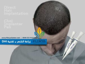 Read more about the article تقنية DHI اقلام تشوي في زراعة الشعر