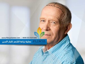 Read more about the article عملية زراعة الشعر لكبار السن