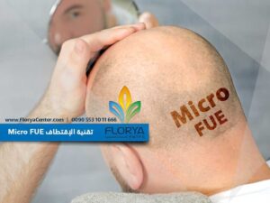 Read more about the article تقنية الإقتطاف Micro FUE في زراعة الشعر