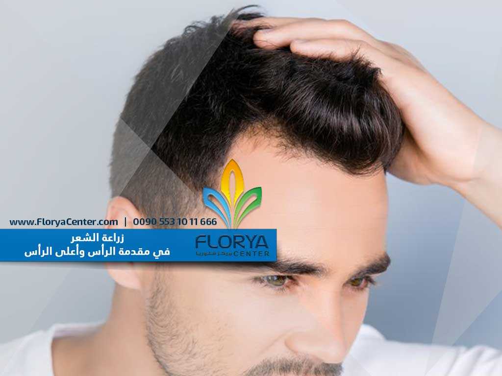You are currently viewing زراعة الشعر في مقدمة الرأس وأعلى الرأس