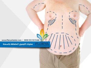 Read more about the article عمليات التجميل المتعلقة بالسمنة