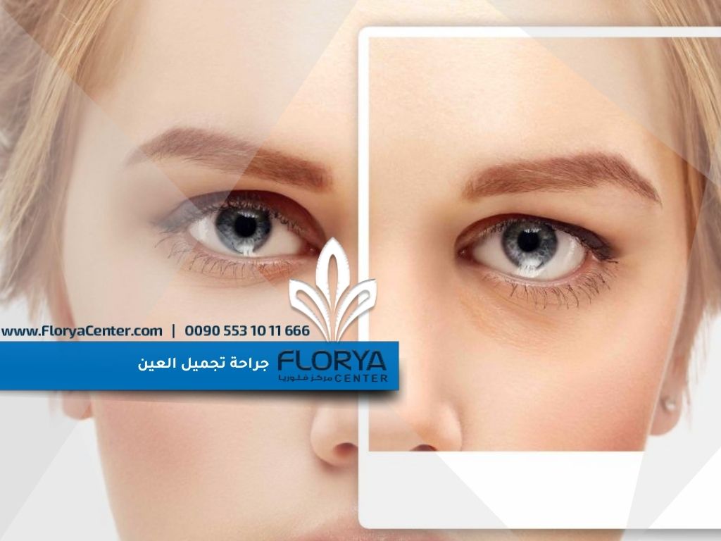 Read more about the article جراحة تجميل العين