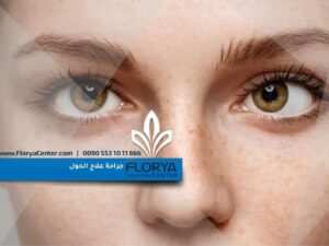 Read more about the article جراحة علاج الحول