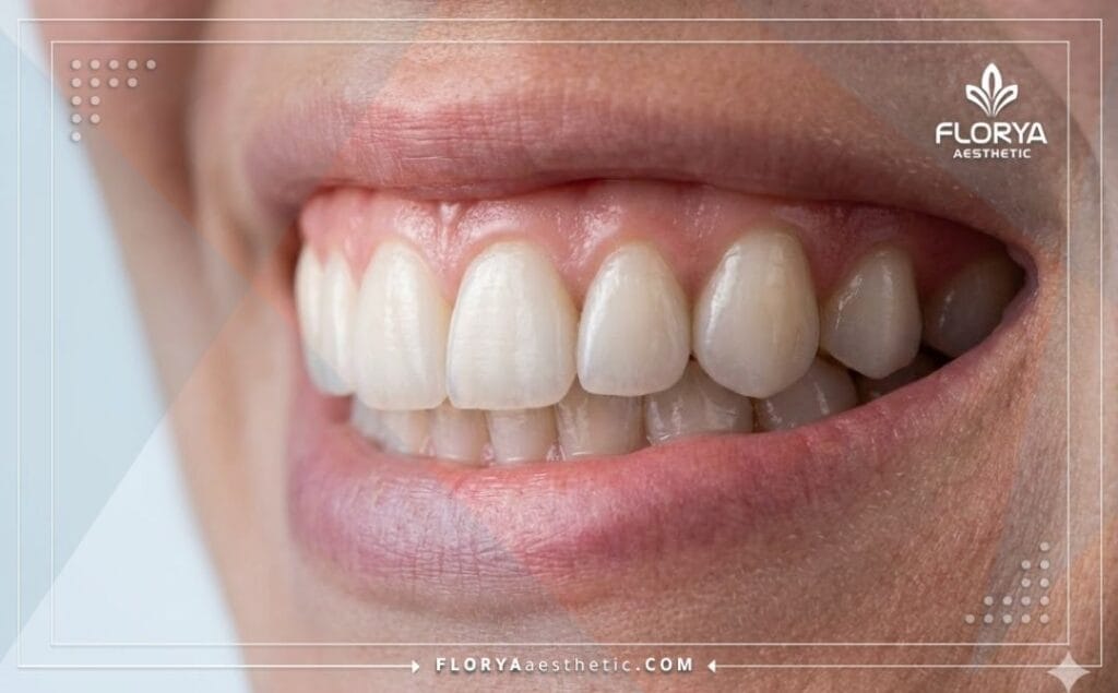 Primer plano de una sonrisa perfecta con coronas de zirconio
