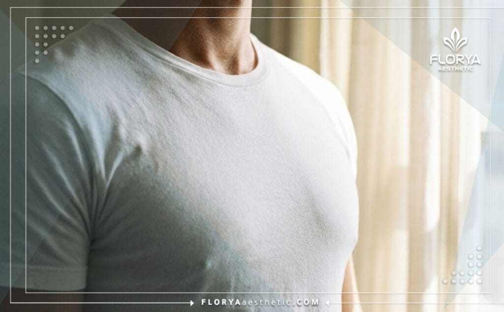 Resultado exitoso de ginecomastia mostrando un pecho masculino plano