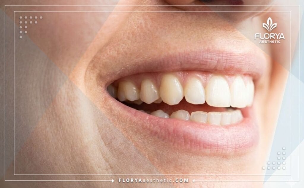 Gros plan sur un sourire éclatant après un plombage réussi