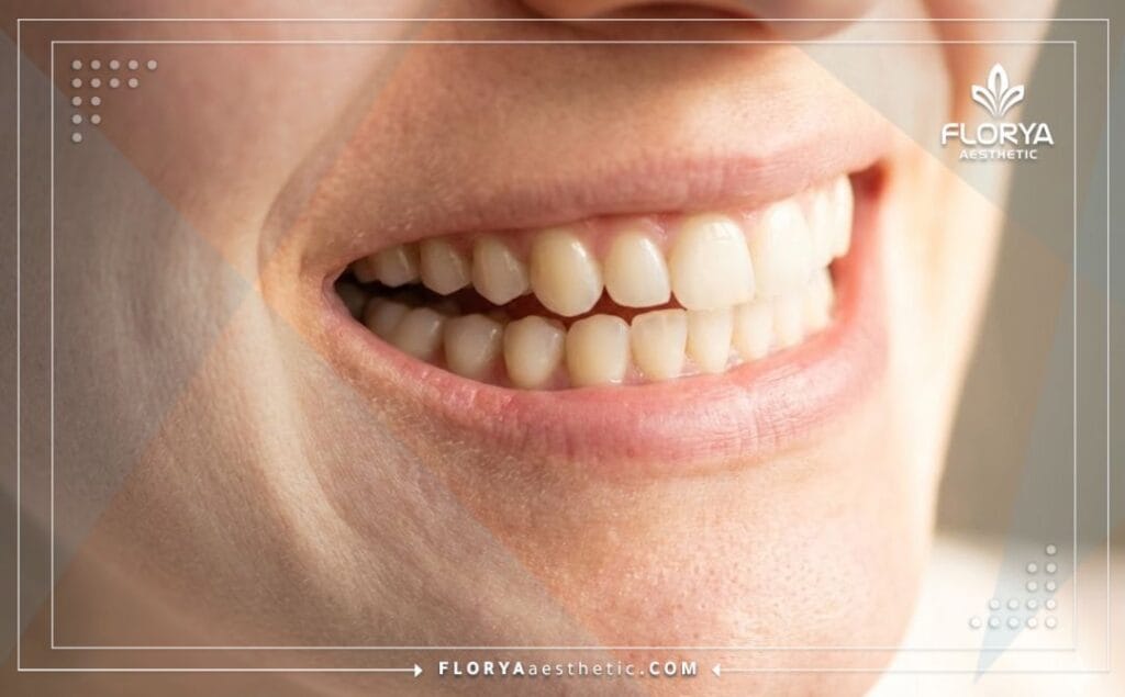 Close-up of a flawless restored tooth demonstrating the perfect result of dental fillings