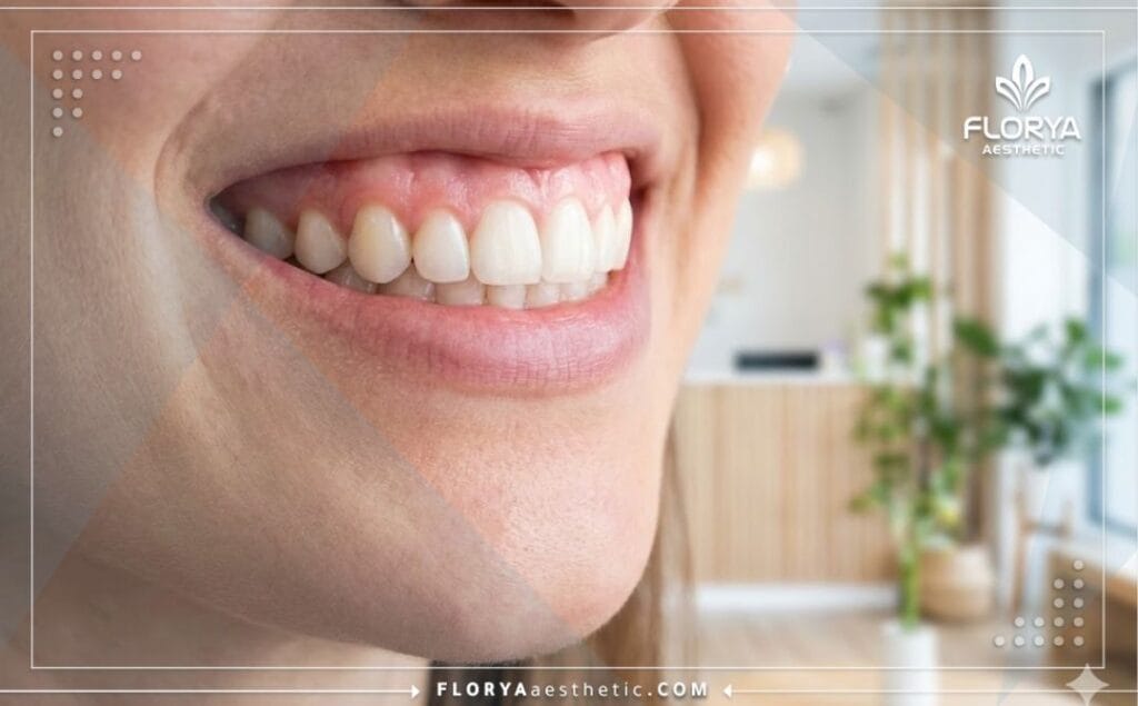 صورة مقربة تظهر النتيجة المثالية واللثة الصحية الوردية بعد الجراحة التجميلية.