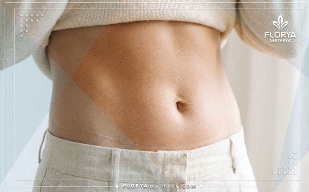 Close-up of a perfectly toned abdomen showing the result of a mini tummy tuck.