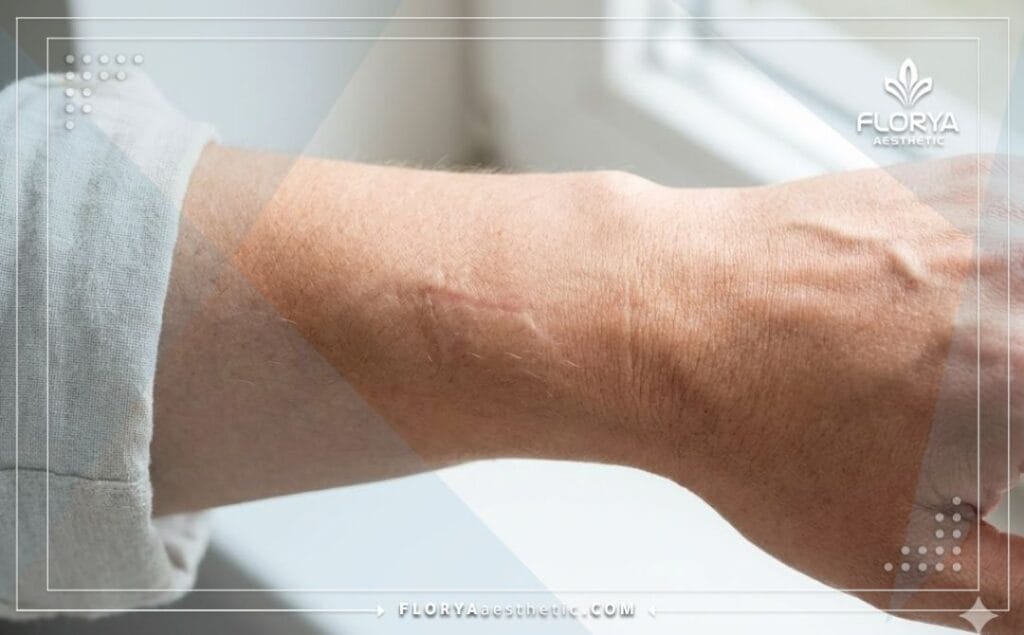 Résultat parfait montrant un membre aligné après reconstruction osseuse