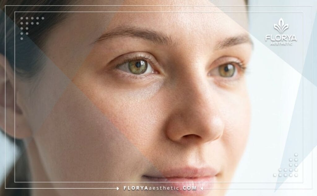 Flawlessly smooth and refreshed under-eye area showing the result of dermal fillers