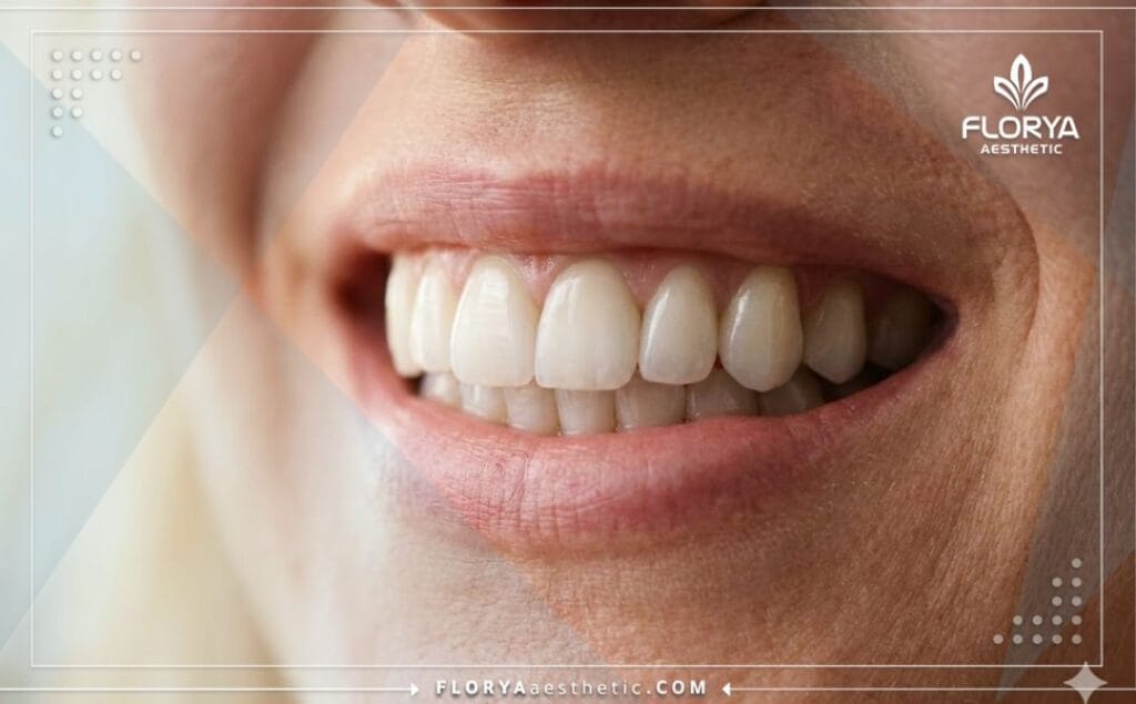 Gros plan sur un sourire éclatant montrant le résultat parfait des couronnes en zircone