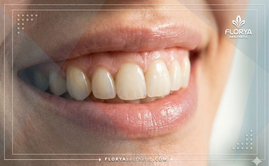 Gros plan sur un sourire parfait et blanc, résultat des Couronnes en Zircone en Turquie.