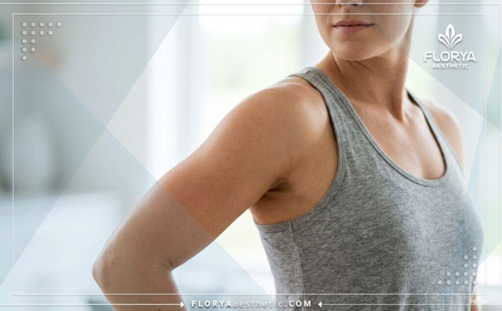 Flawless aesthetic result of successful arm contouring.