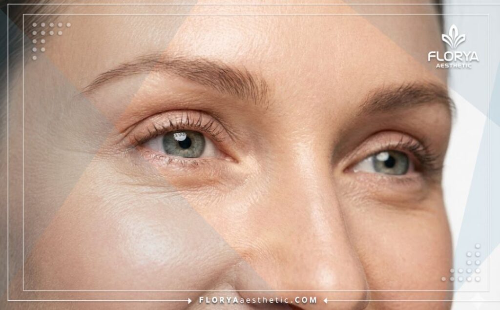 Идеальный и естественный эстетический результат после пластики век крупным планом