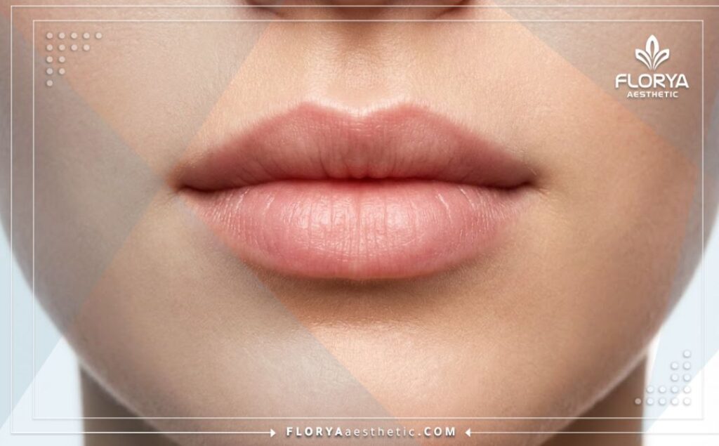 Cinematic close-up of a perfect, natural, and aesthetic lip lift surgical result.