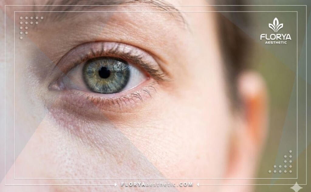 Крупный план здорового глаза после успешной операции.