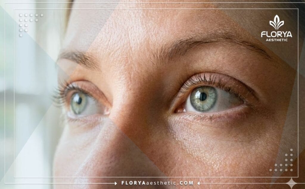 نتيجة مثالية وناجحة لعملية تجميل العيون تبرز المظهر الشبابي والطبيعي.