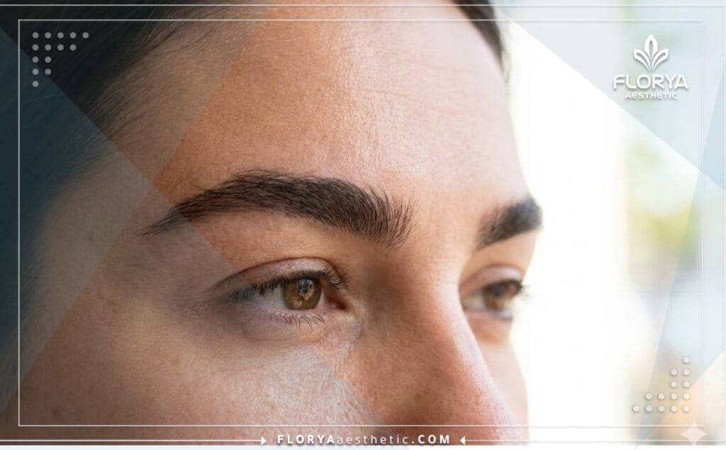 Perfect, thick, and natural result of the transplant.