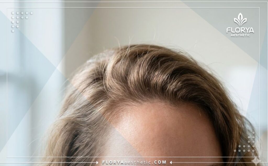 Идеальный и густой результат восстановления передней линии роста волос.