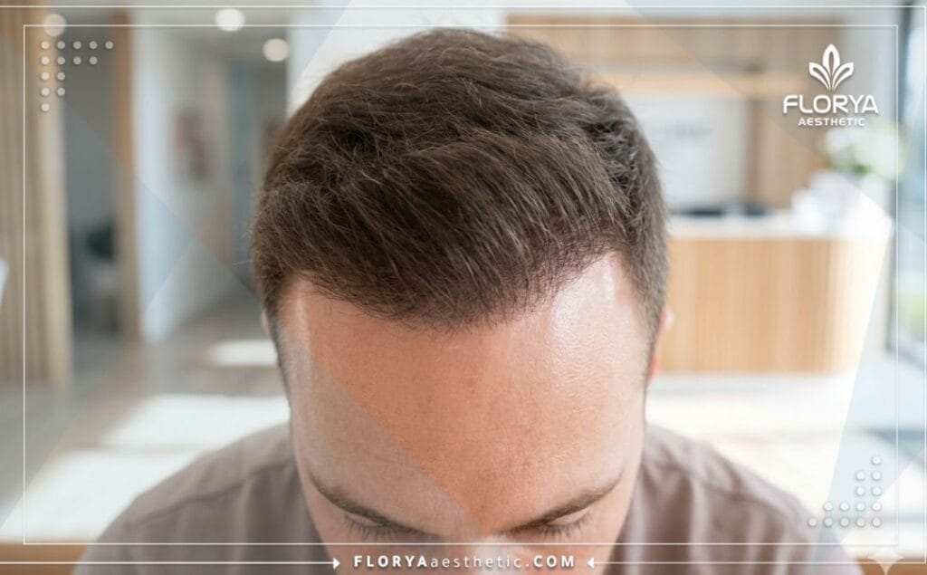 نتيجة مثالية وطبيعية لعملية زراعة الشعر بنجاح تام