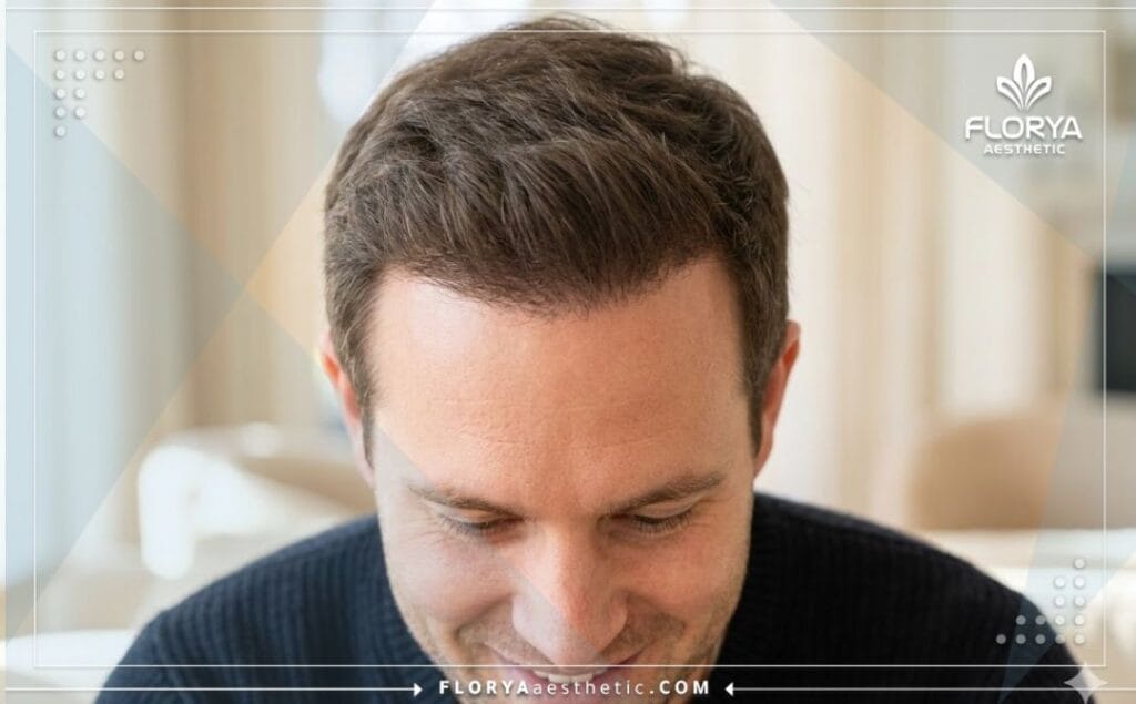 نتيجة مثالية وكثافة طبيعية لخط الشعر الأمامي