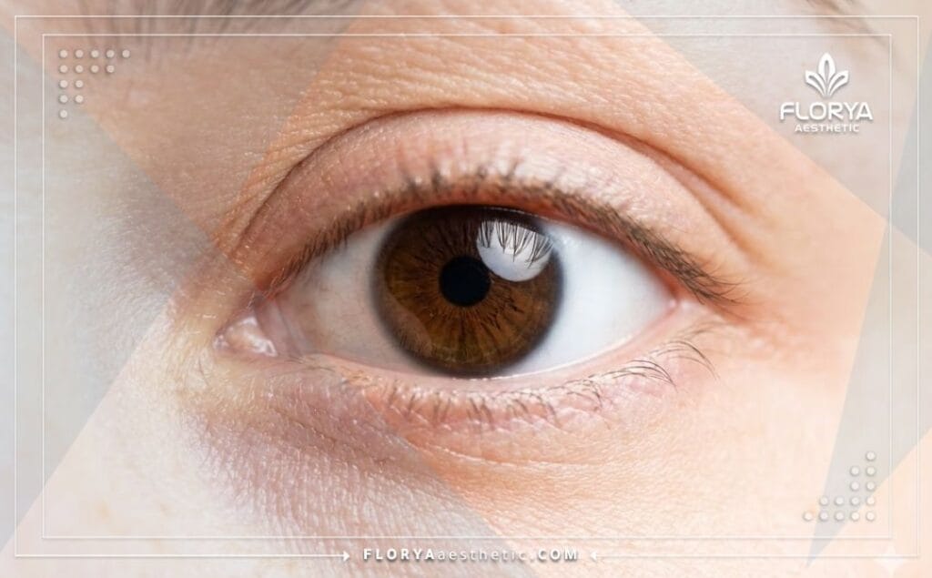 Close-up of a healthy, clear eye demonstrating the perfect result of keratoconus treatment.