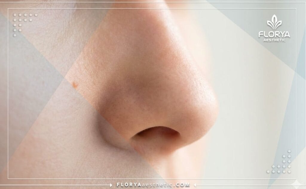Gros plan sur le résultat parfait d'un nez affiné et sculpté après chirurgie.