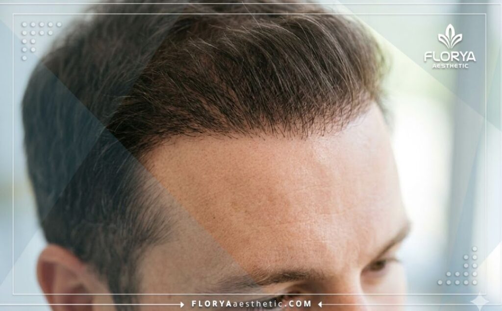 نتيجة مثالية وخط شعر طبيعي وكثيف بعد إجراء العملية.