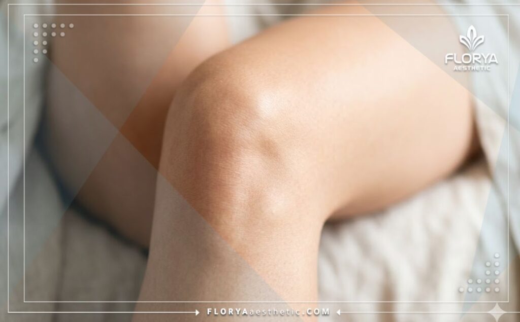 ركبة صحية بعد التعافي التام بفضل الإجراء الطبي الناجح.