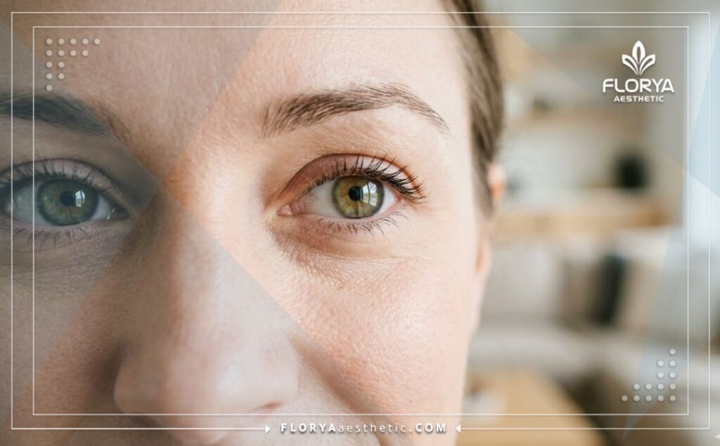 Идеальный результат после лазерной коррекции зрения