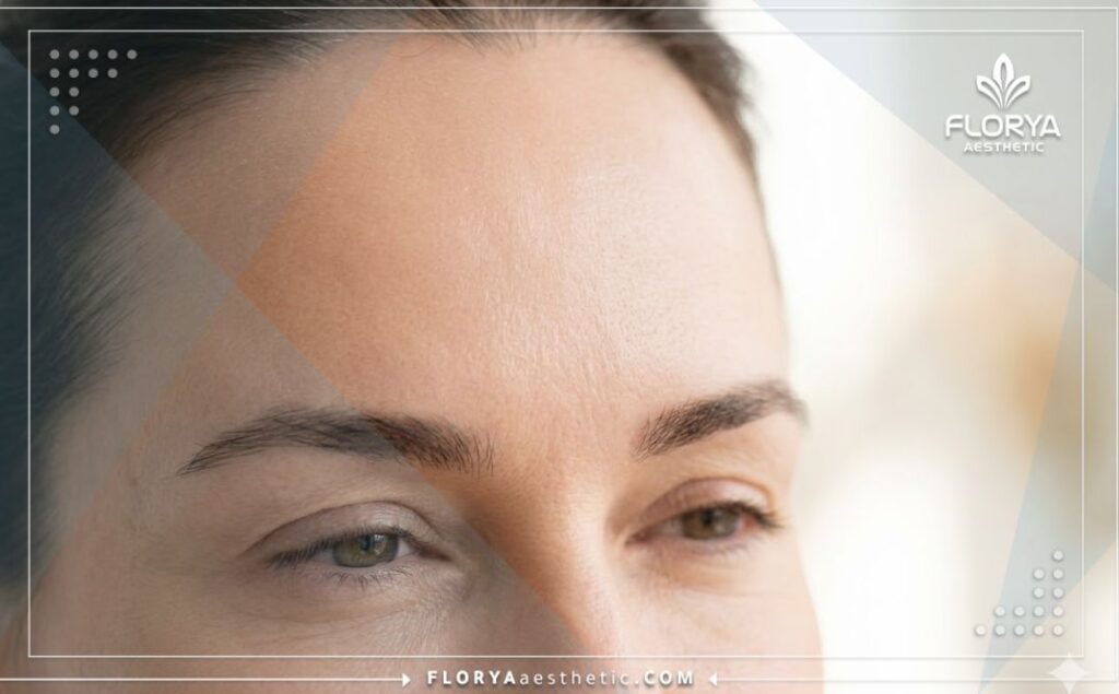 نتائج جمالية مثالية وطبيعية لمنطقة الجبهة بعد عملية التجميل.