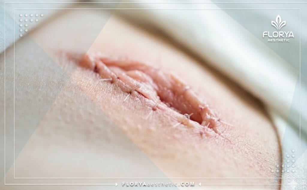 Cinematic focus on the perfect and aesthetic surgical result