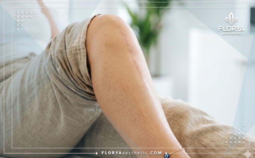 Résultat parfait et guérison complète après une intervention orthopédique réussie.