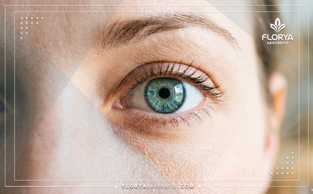 Œil clair et magnifique montrant le résultat parfait de la chirurgie PKR.