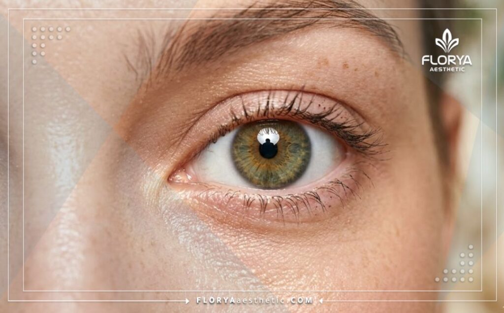 نتيجة مثالية وعين صافية تماماً بعد عملية تصحيح النظر واستبدال العدسة