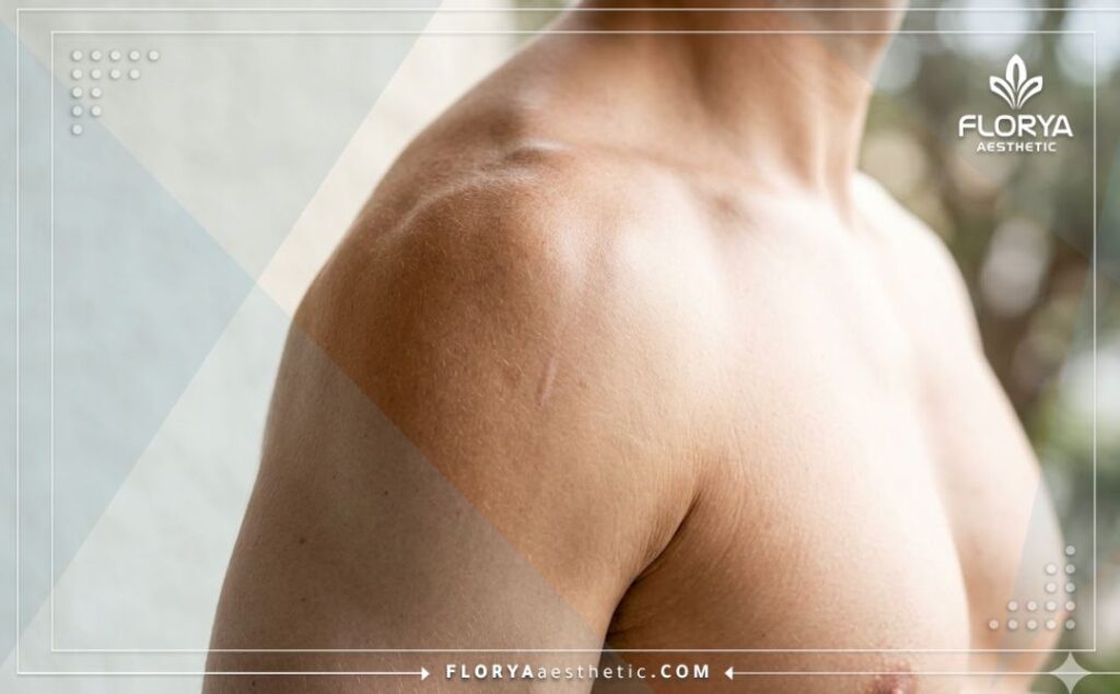 نتيجة مثالية وناجحة لتعافي مفصل الكتف بعد الجراحة بفضل الرعاية الطبية الفائقة.