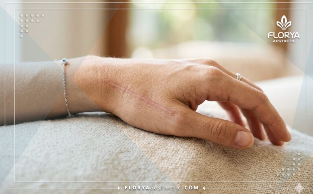 Perfect healed tendon result showing aesthetic natural recovery.