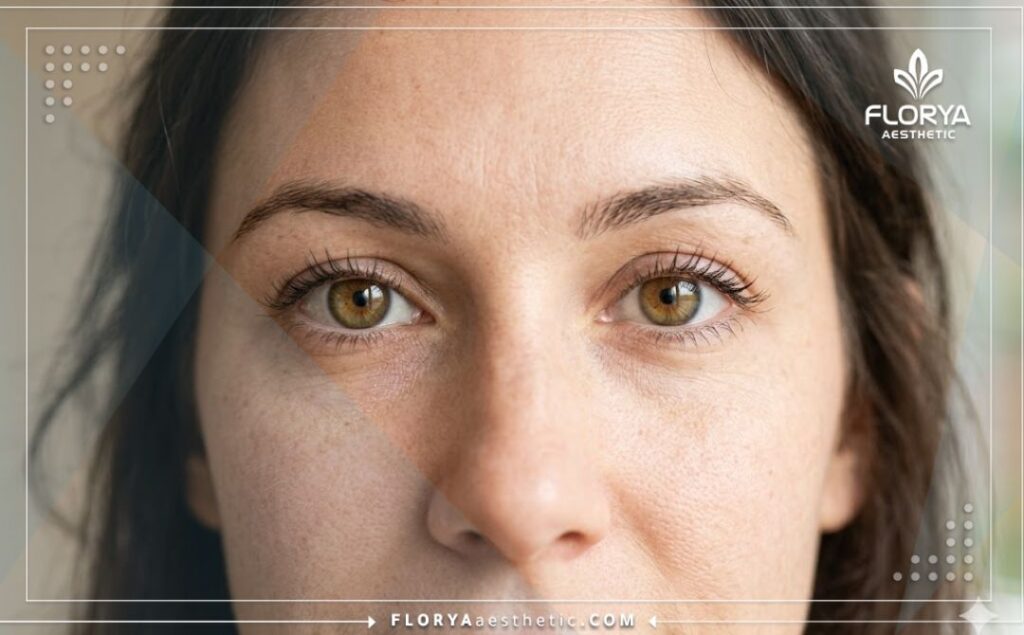 Идеальный результат выравнивания глаз после успешной процедуры