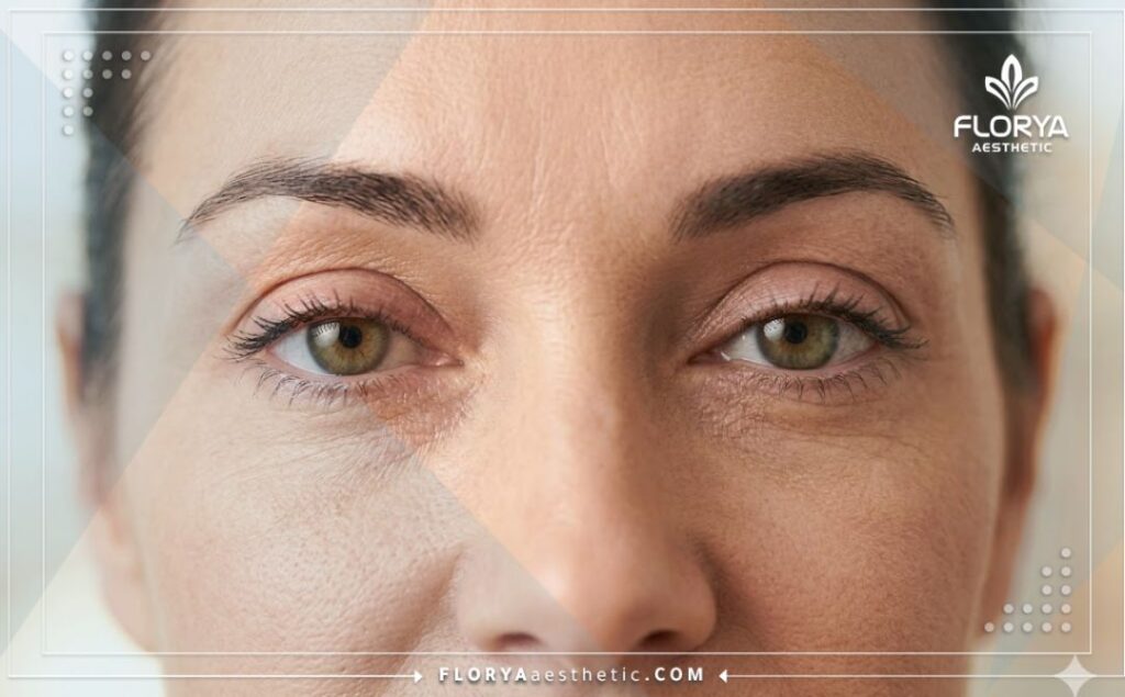 Primer plano cinematográfico del resultado perfecto de la cirugía de párpados.