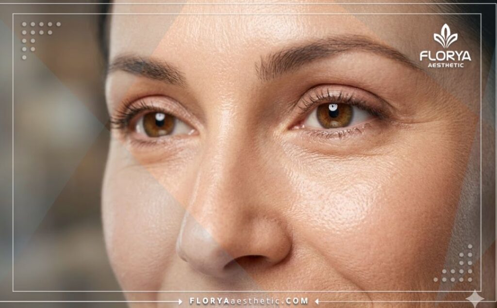 Идеальный и естественный результат омоложения области вокруг глаз