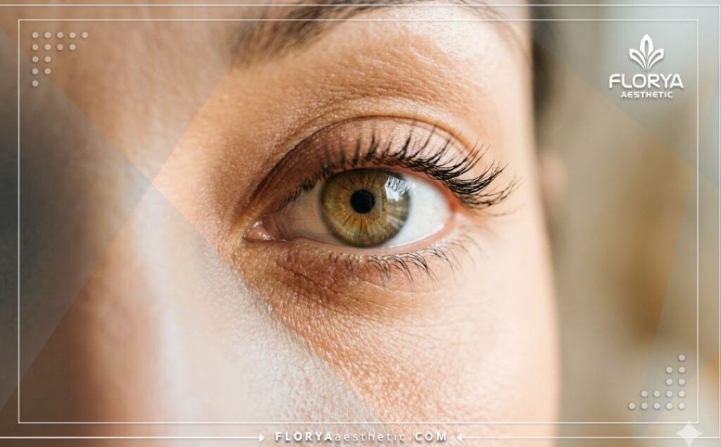 Close-up showing the flawless and beautiful eye resulting from successful refractive laser surgery.