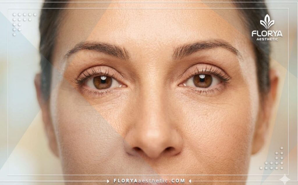 Cinematic close-up showing the flawless and natural results of laser eyelid aesthetics