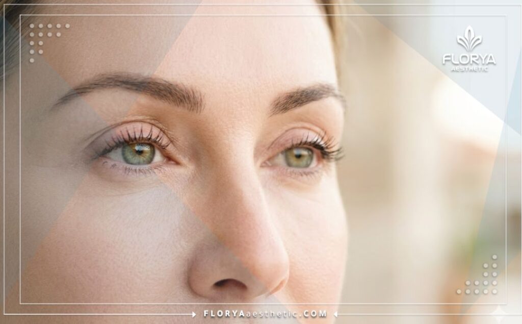 Идеальный эстетический результат после лазерной подтяжки кожи вокруг глаз