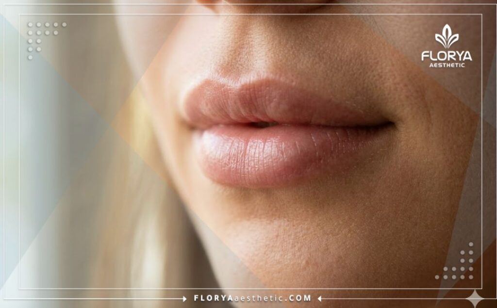 Flawless and successful outcome of natural lip enhancement