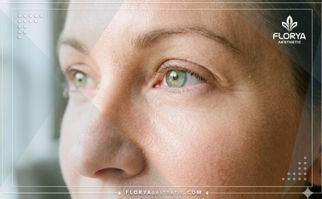 Идеальный результат операции на нижних веках